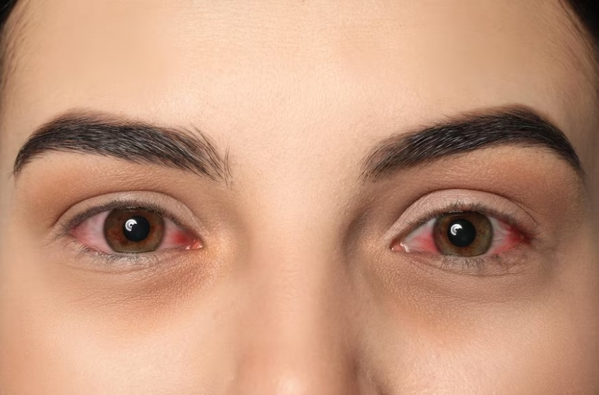 Tại sao đau mắt đỏ phải đeo kính râm? Lý giải từ chuyên gia